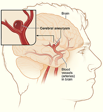 Aneurisma cerebral