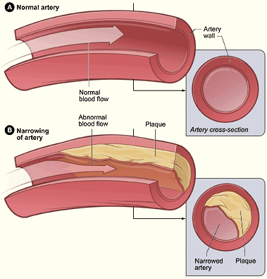 Aterosclerosis