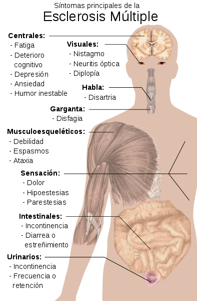 Esclerosis múltiple