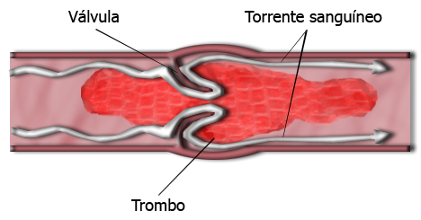 Vena en la que aparece un tómbolo taponándola y un émbolo desplazándose 