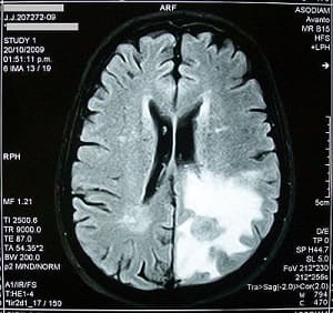 Tumor cerebral visto a través de una imagen electrónica